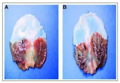 calcified pineal gland